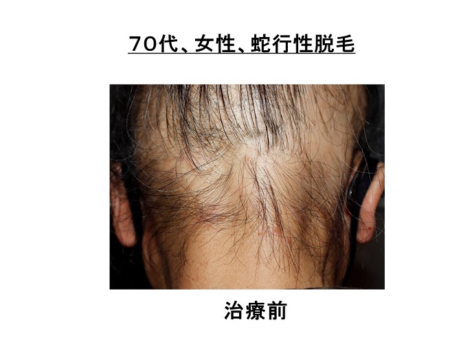 円形脱毛症　病院